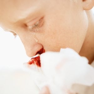 What to do when your child gets a nosebleed.