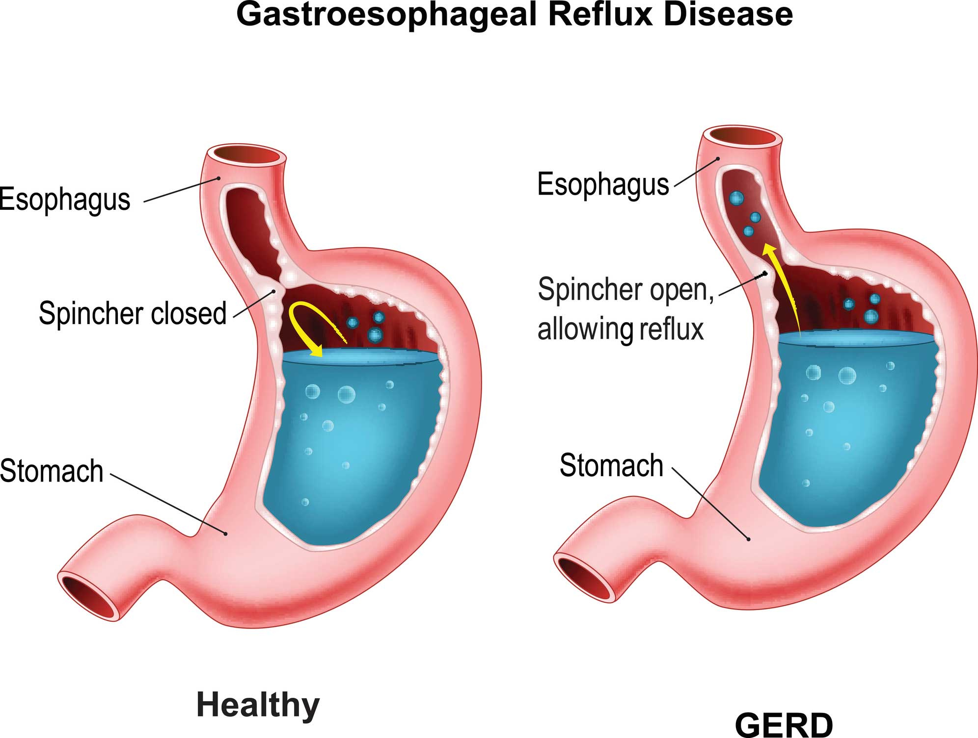 How do you get rid of acid reflux in your throat
