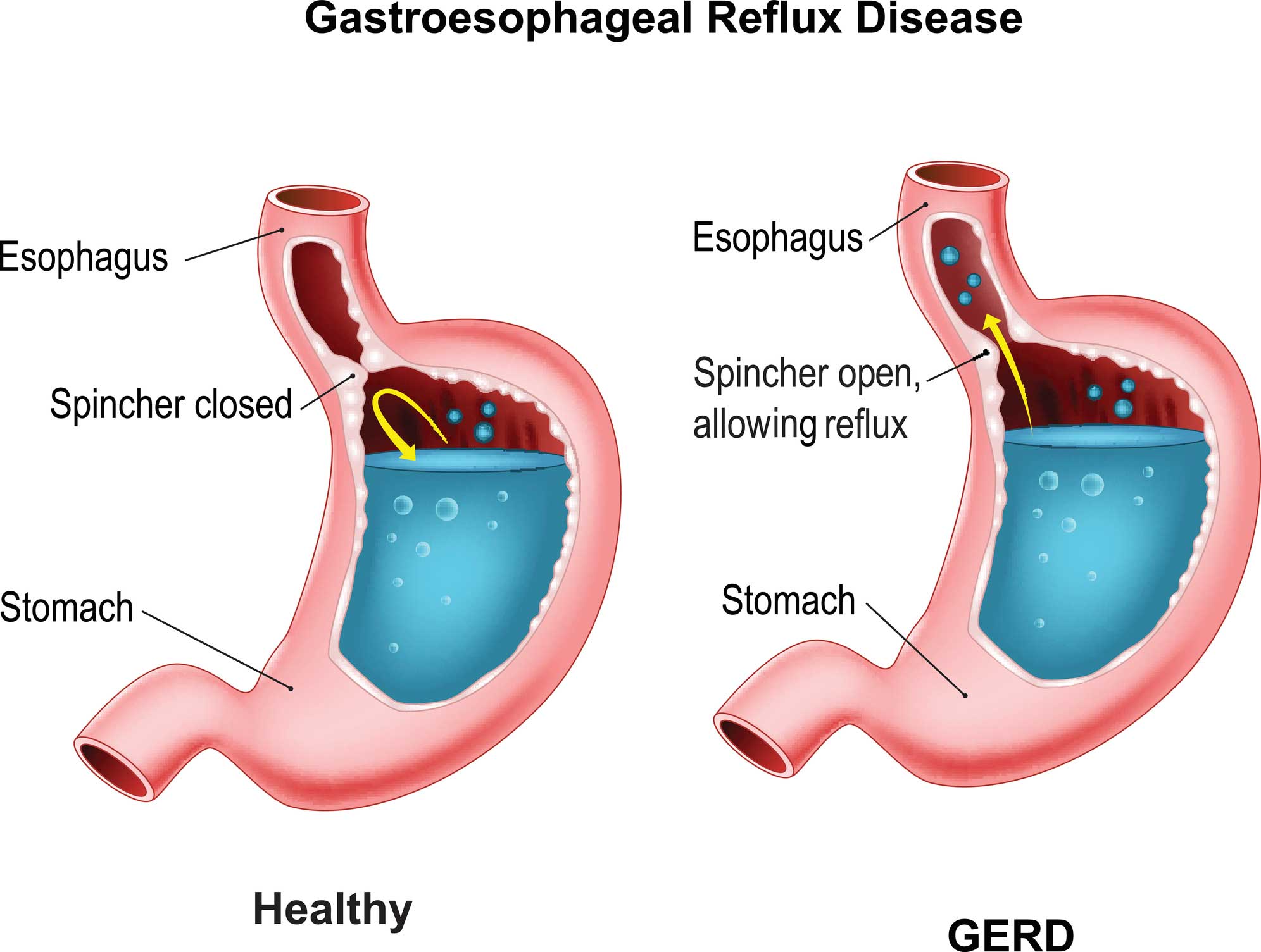 Stomach Cancer Cause Acid Reflux