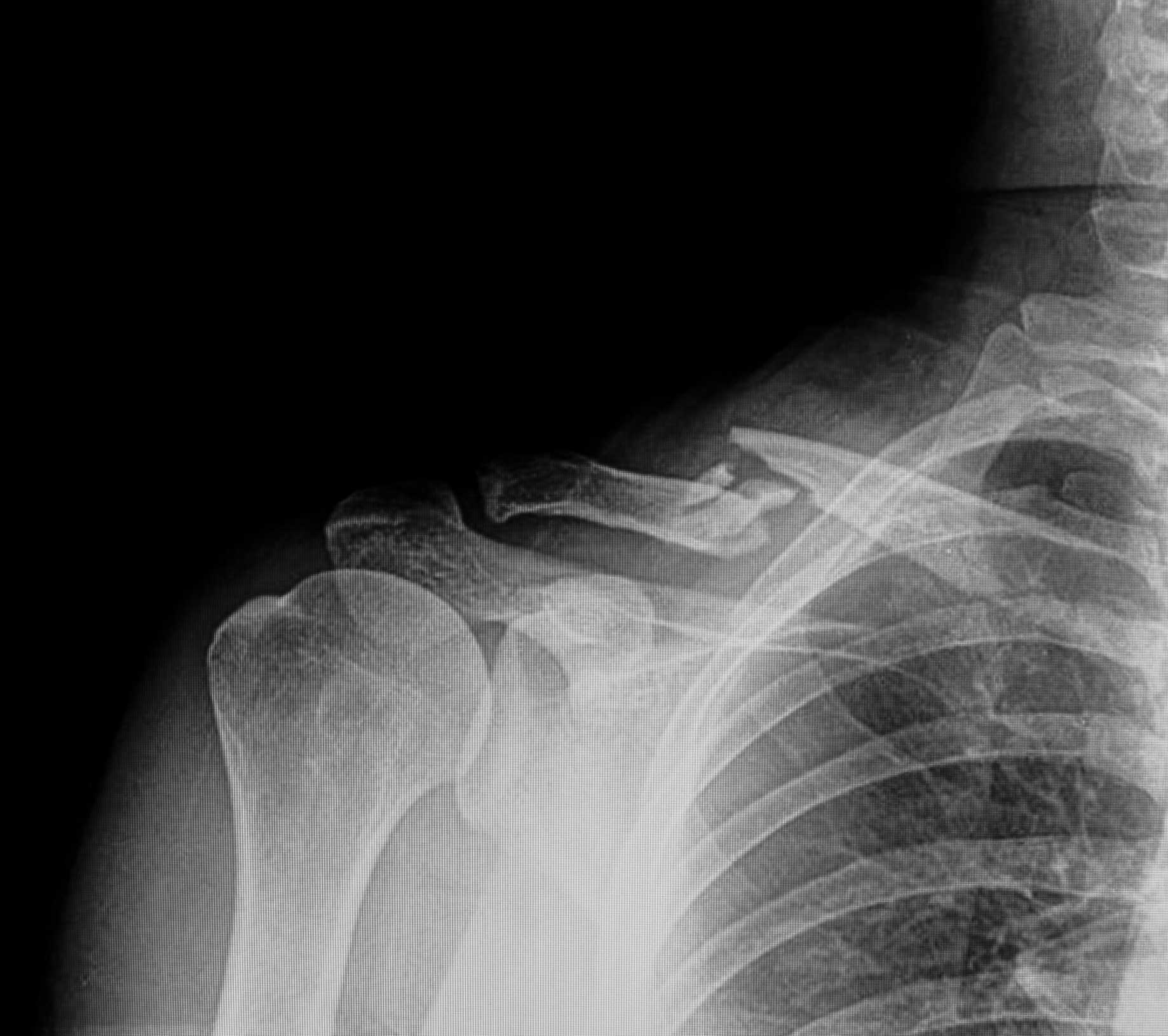 X-ray of broken collarbone.