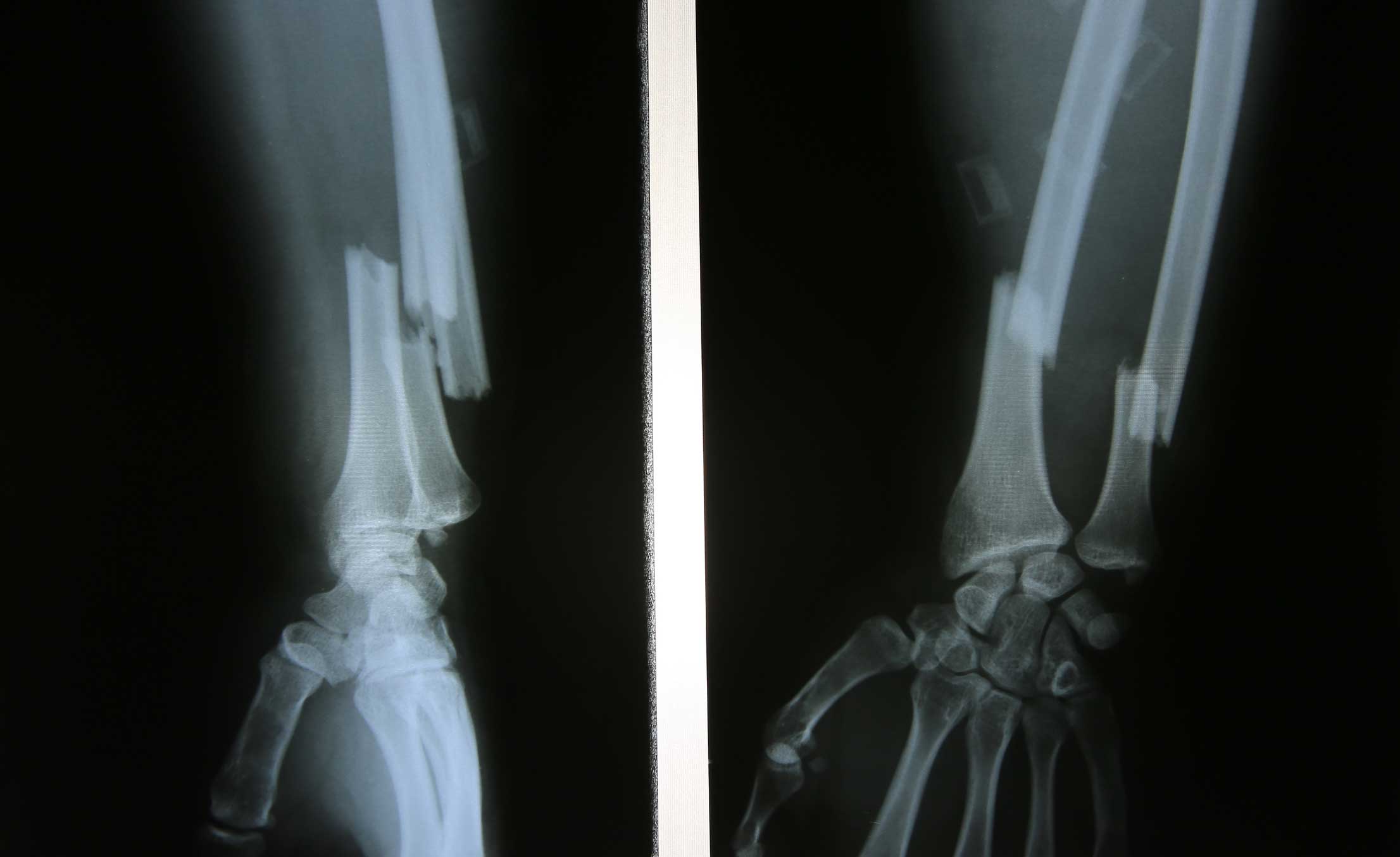 ulna bone fracture