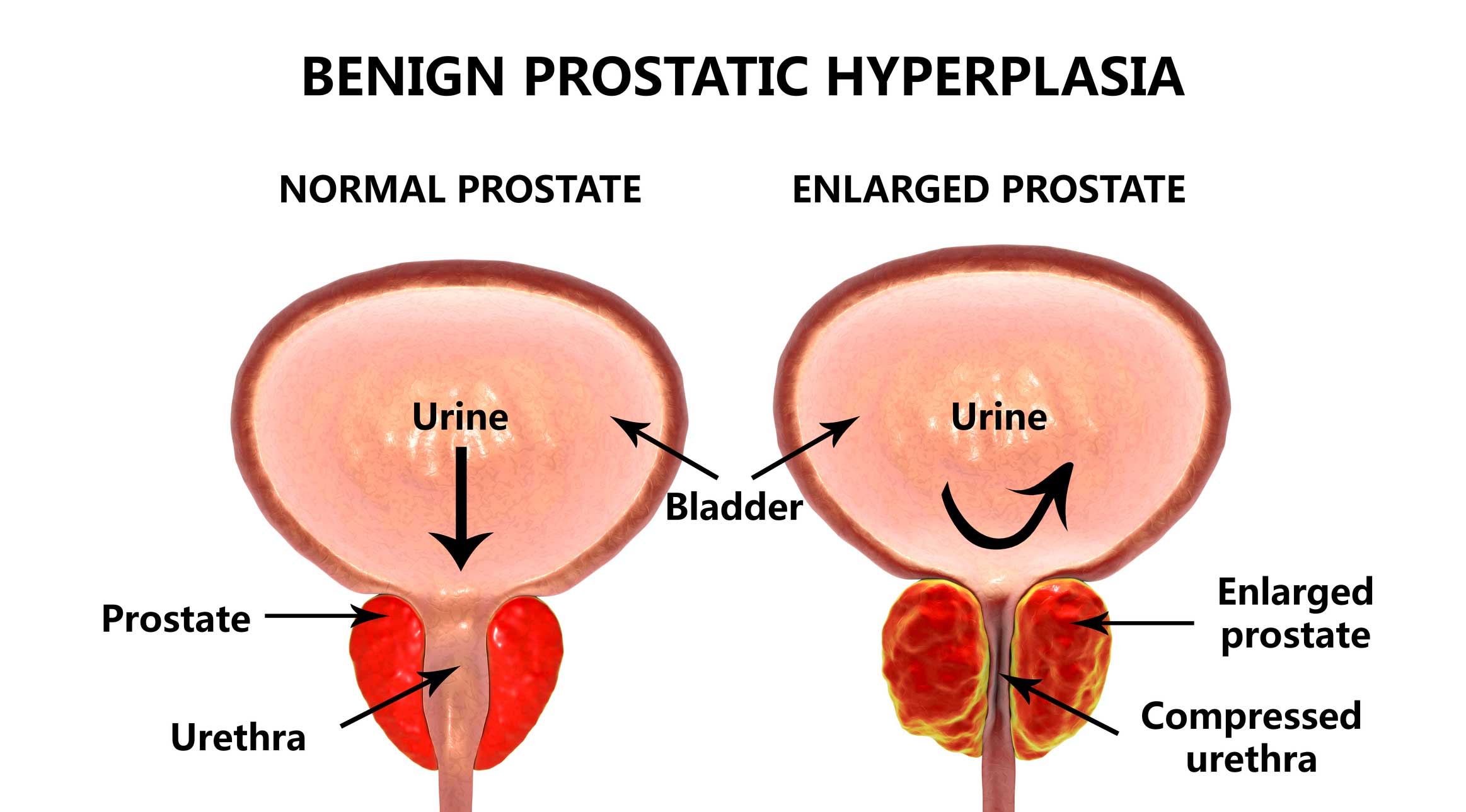 Enlarged prostate.