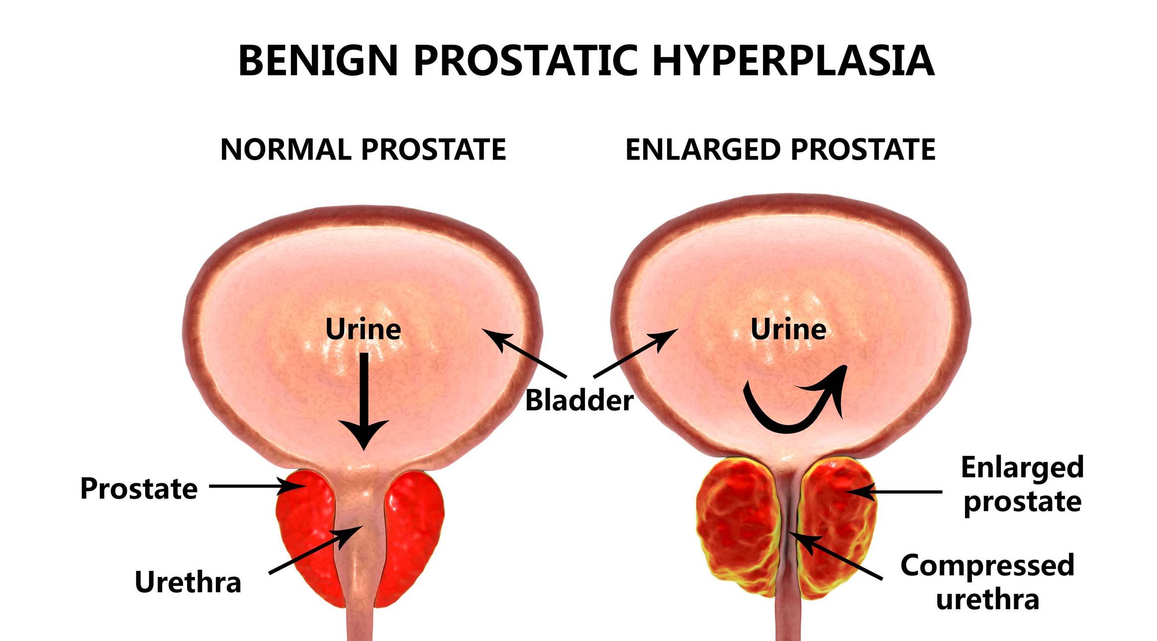 Urolift New Relief From Enlarged Prostate Health News Hub 