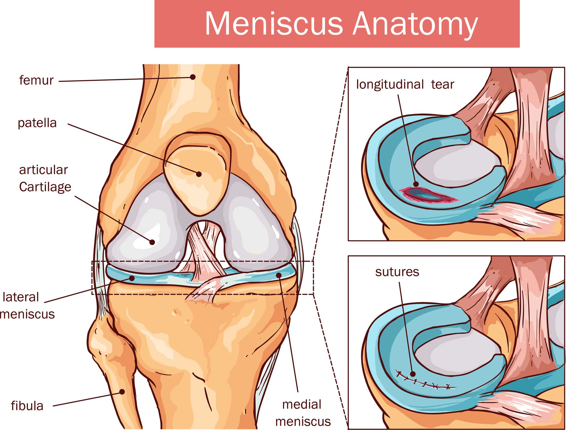 Does A Torn Meniscus Show Up On An X Ray