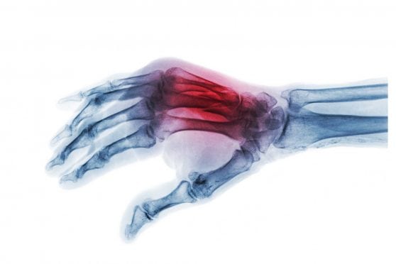 Fracture at 3rd and 4th metacarpal bone