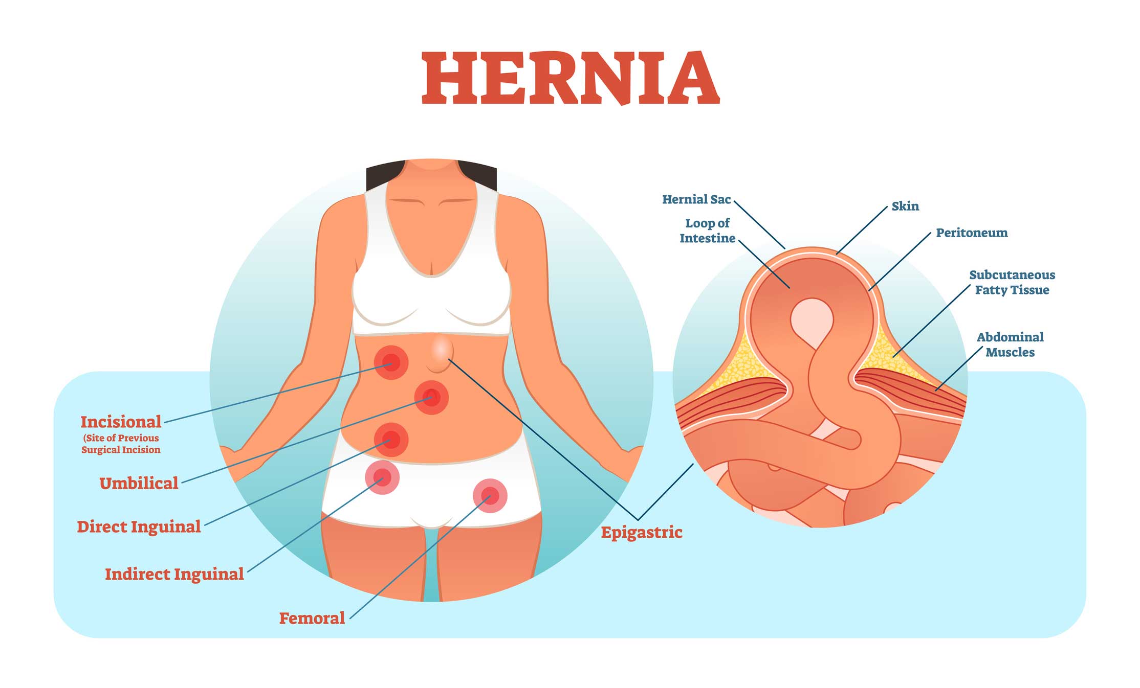 woman hernia