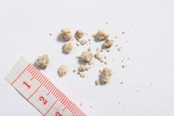 The Making of a Kidney Stone (And How to Avoid It) - Health News Hub