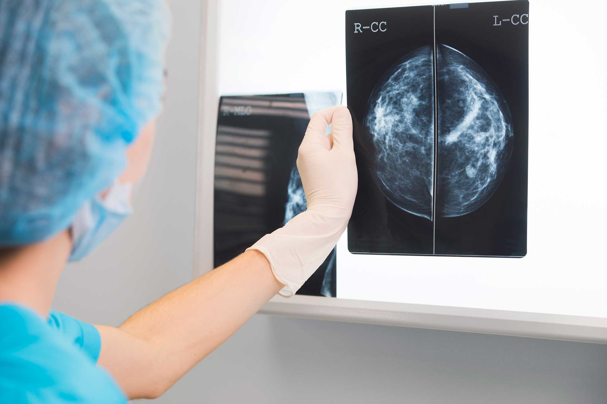 Study: Dense Breasts a Breast Cancer Risk Factor