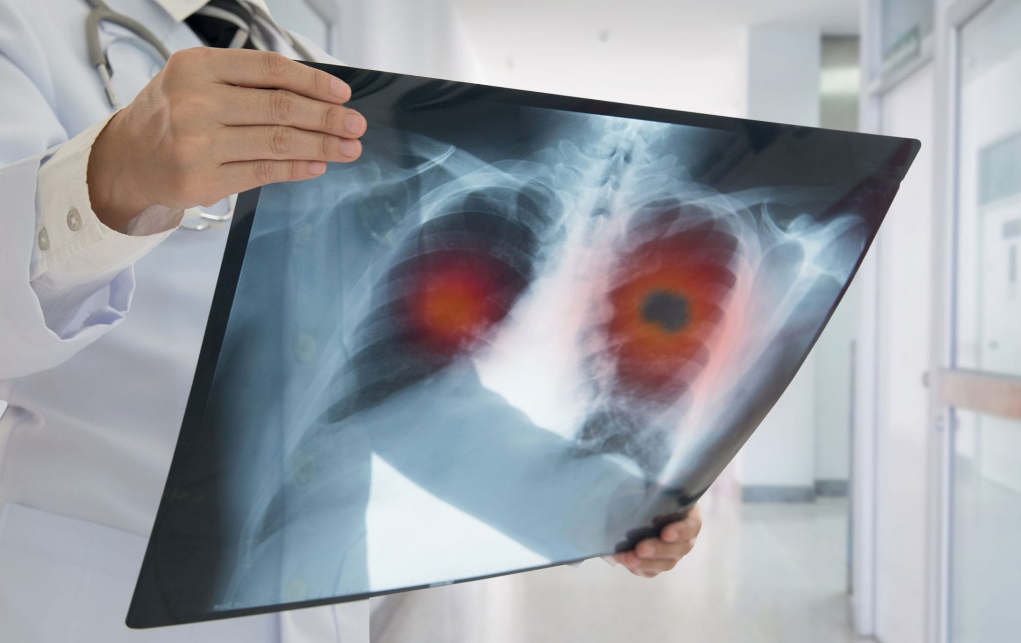 Over-50 Lung Cancer Screening Rates Lag: Here&#8217;s What They&#8217;re Missing