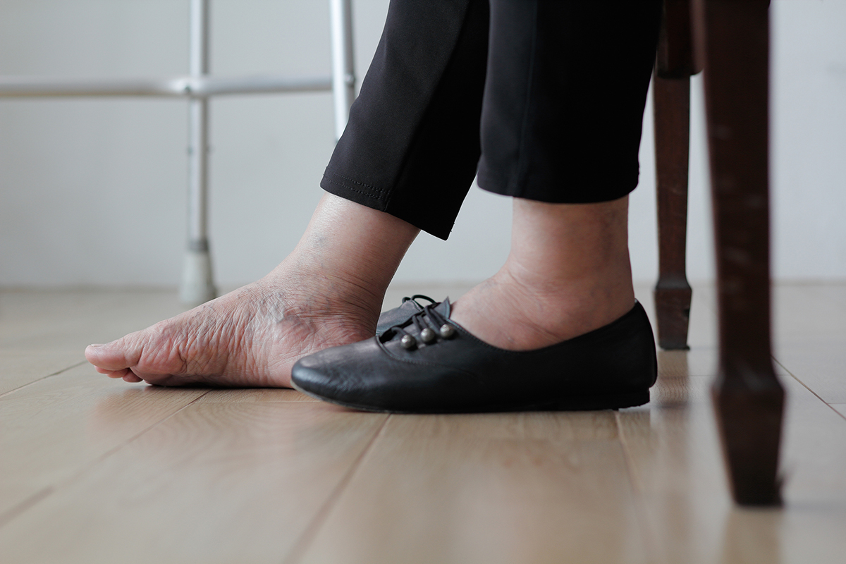 How Therapy Offers Relief From the Swelling of Lymphedema