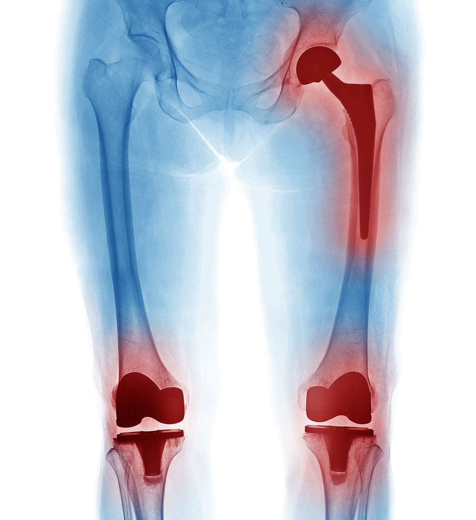 Joint Replacement Lifespan