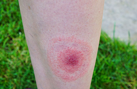 5 Common Summer Rashes and How to Prevent Them