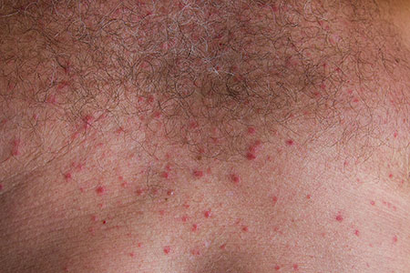 5 Common Summer Rashes and How to Prevent Them, Hartford HealthCare