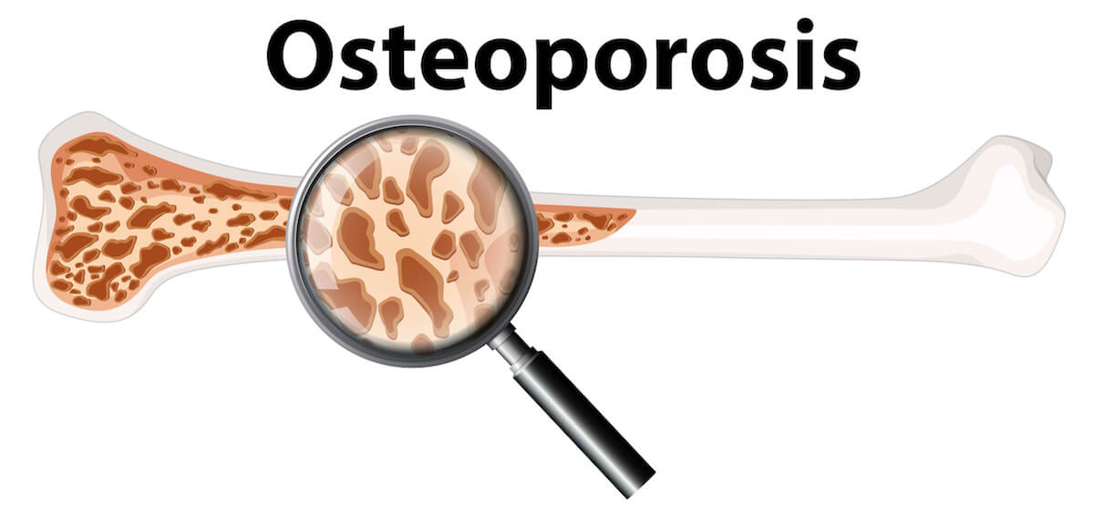 Osteoporosis