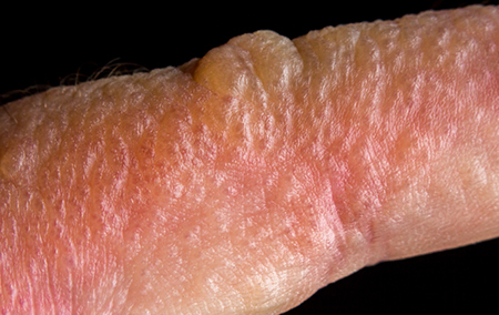 What Does an Allergic Reaction Heat Rash Look Like?