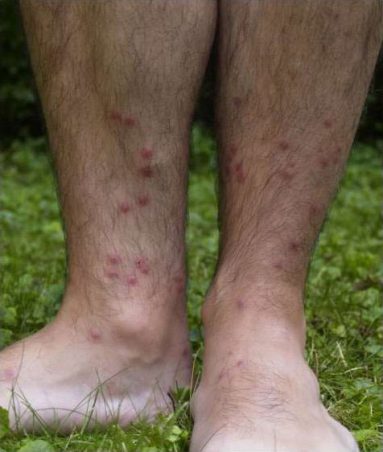 heat rash legs