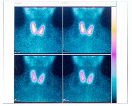 Thyroid Nodule