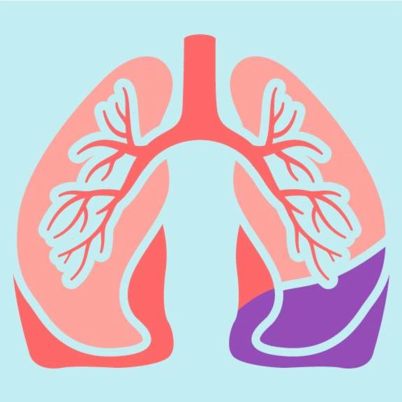 Pulmonary Fibrosis Support Group Meets Oct. 8