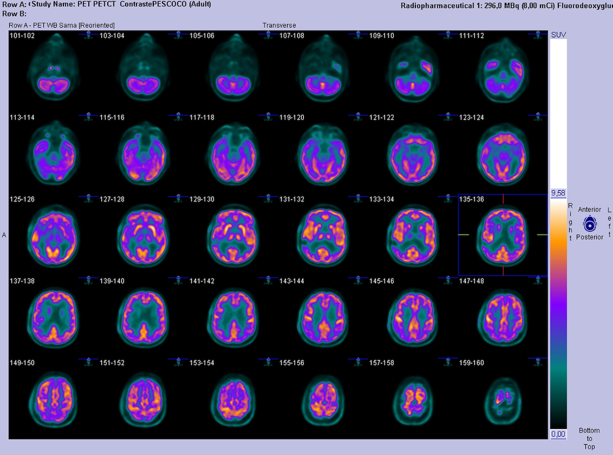 New PET-CT Scanner