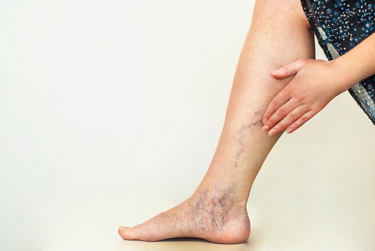 Webinar: Are Varicose Veins Slowing You Down?