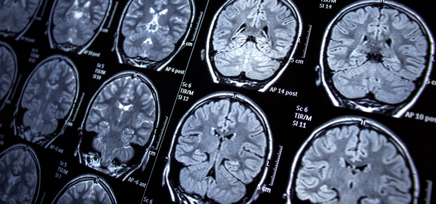 Neurosurgeon Breaks New Ground at HHC with Procedure to Control Seizures