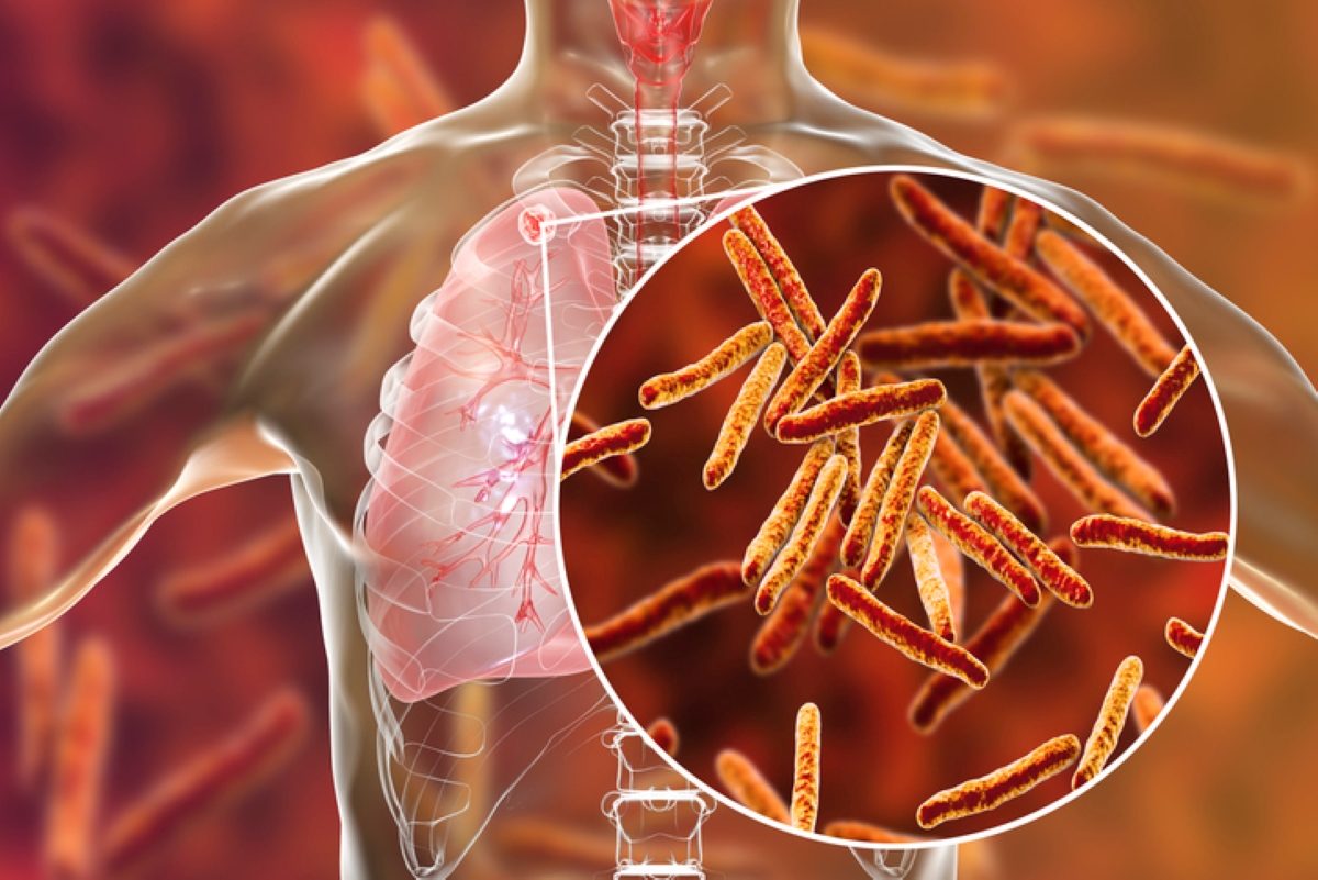In the Midst of COVID, Tuberculosis Cases on the Rise
