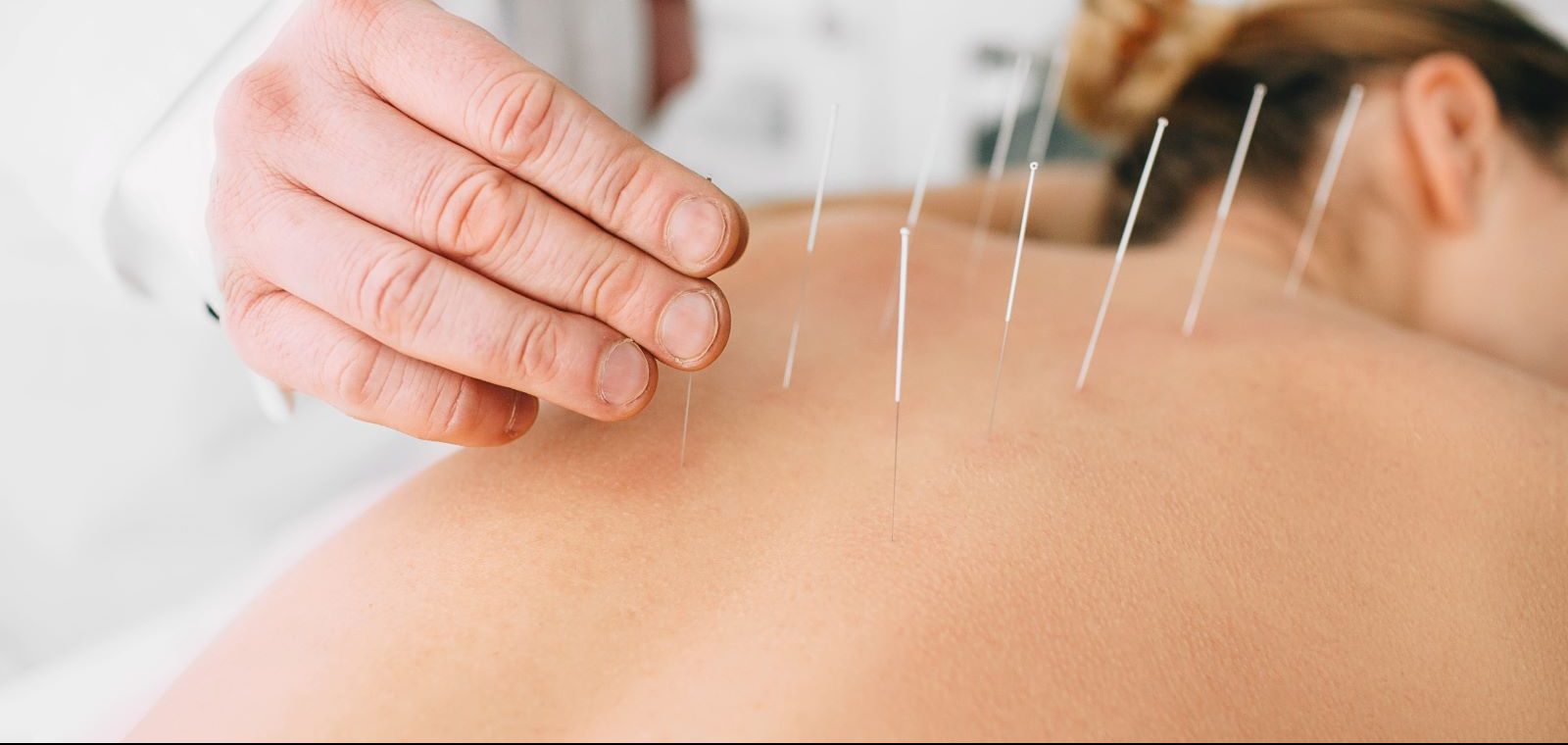 A woman gets acupuncture on her back.