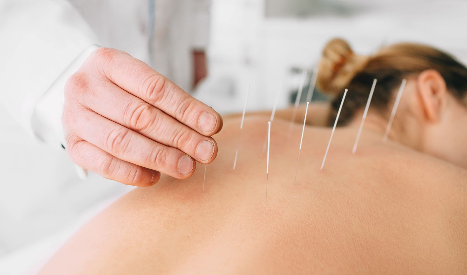 14 Surprising Uses for Acupuncture