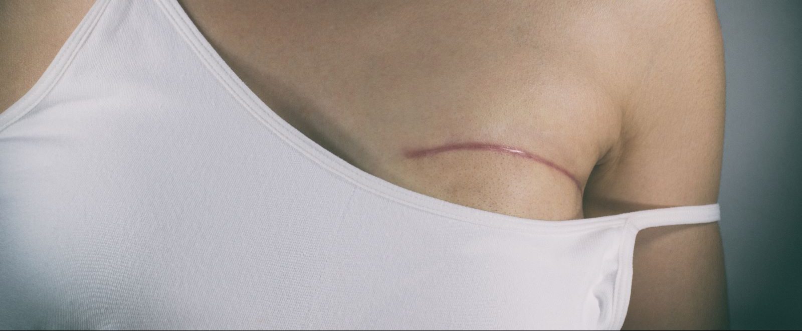 Breast cancer survivor shows her scar.
