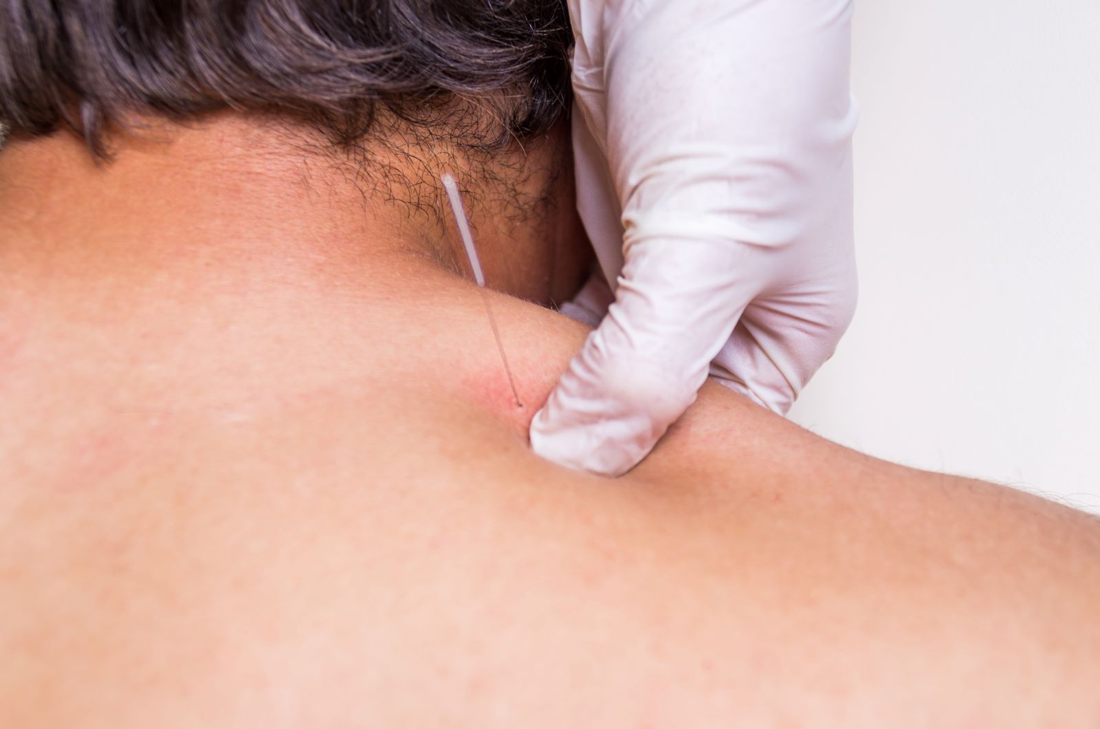 Dry Needling: What Is it and What Does it Do?
