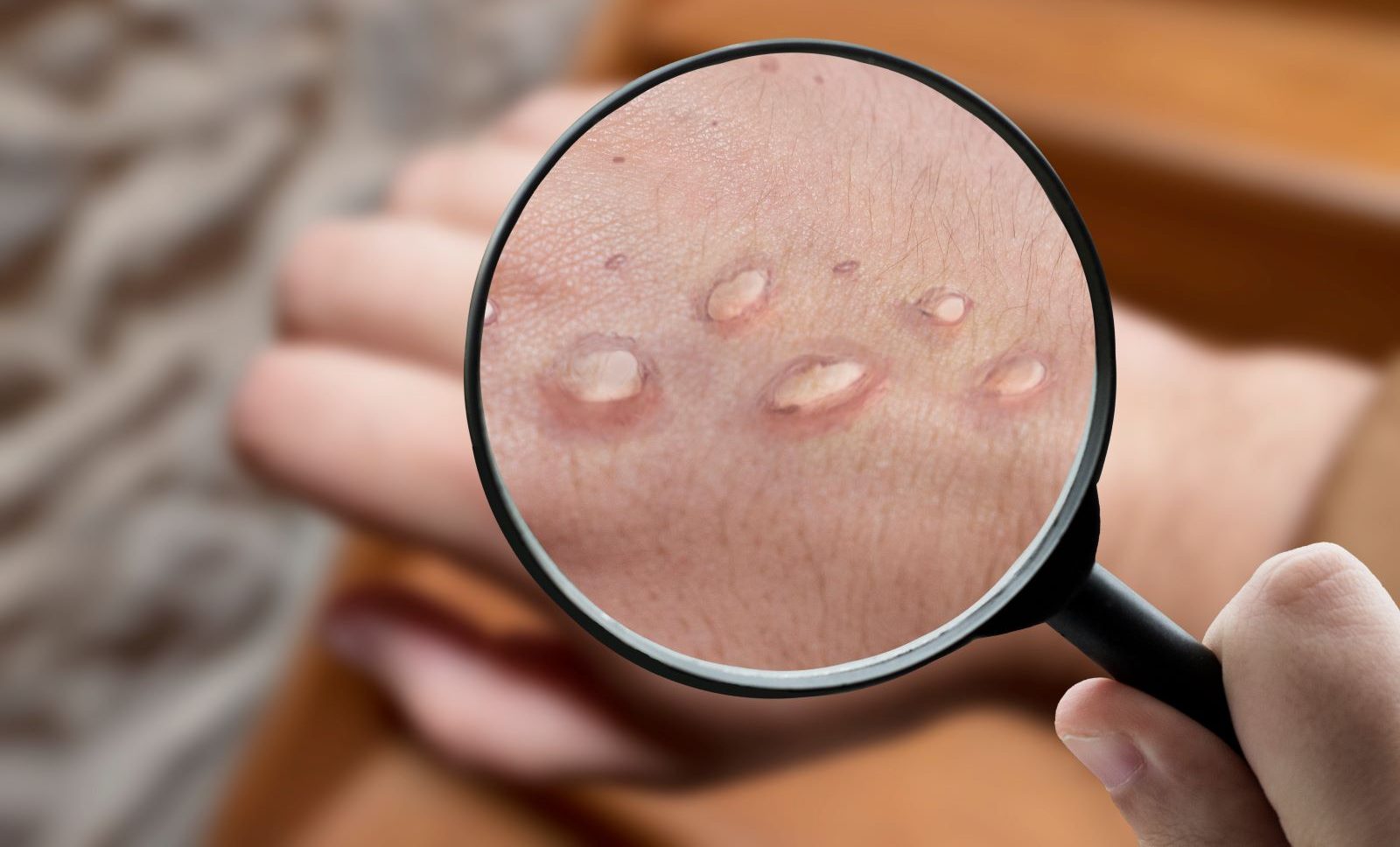 Monkeypox rash shown through a magnifying glass.