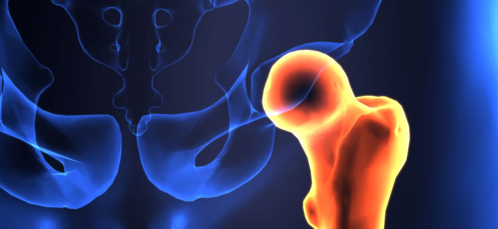 Have you suffered a hip injury? An orthopaedic surgeon explains when patients need a hip replacement for a hip fracture.