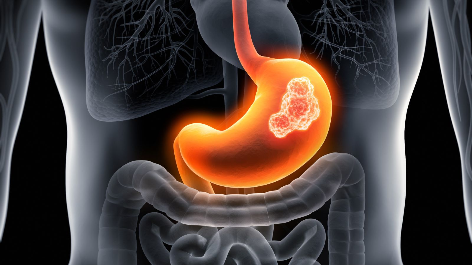 8 Common Symptoms of Gastric Cancer