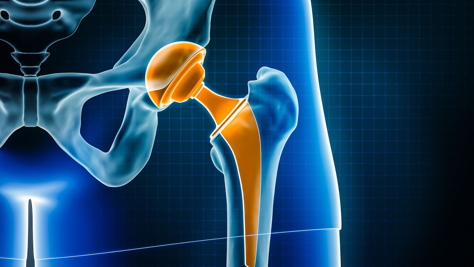 Which Type of Hip Replacement Is Right for Me?