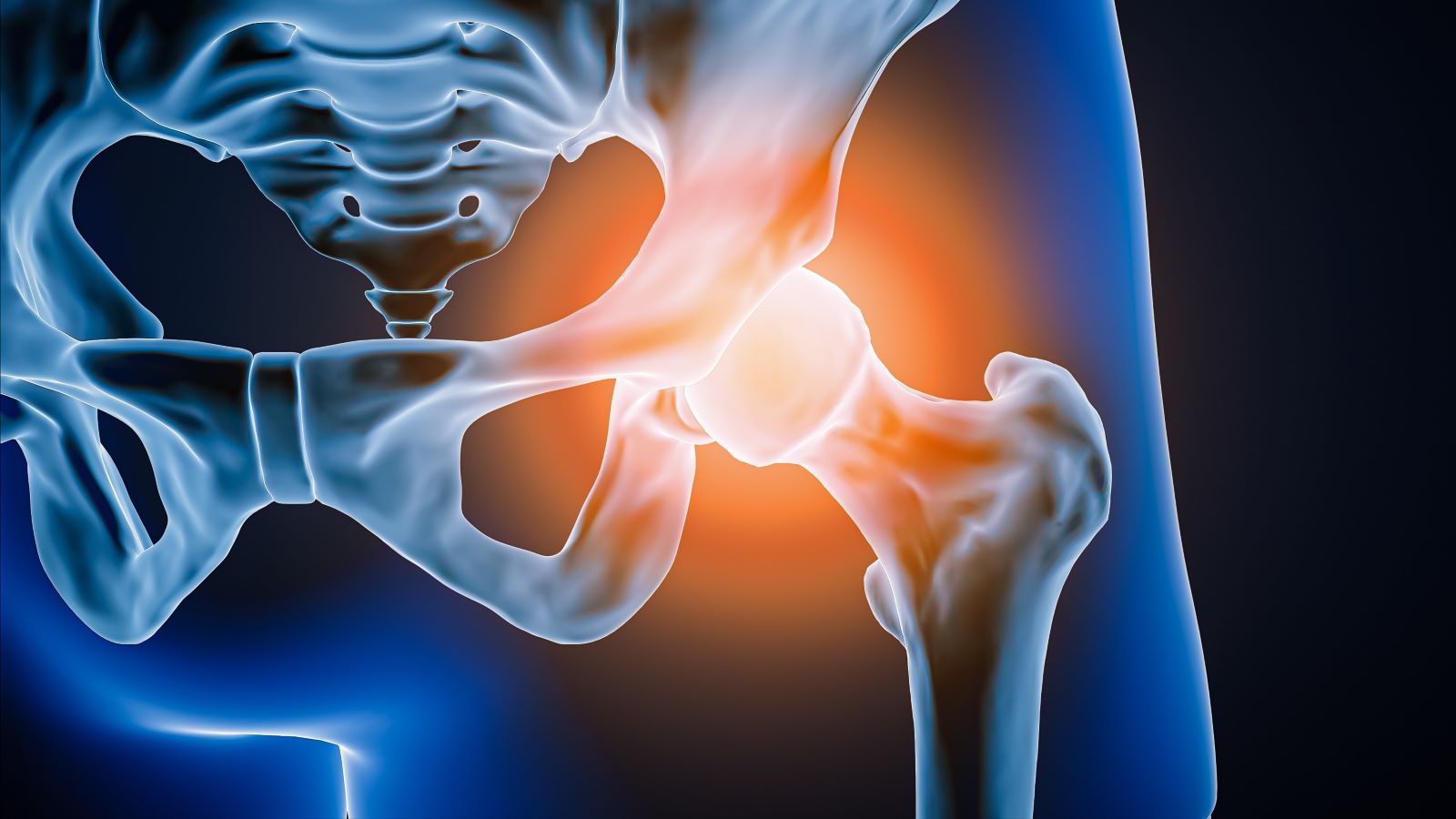 What Not to Do After Hip Replacement Surgery