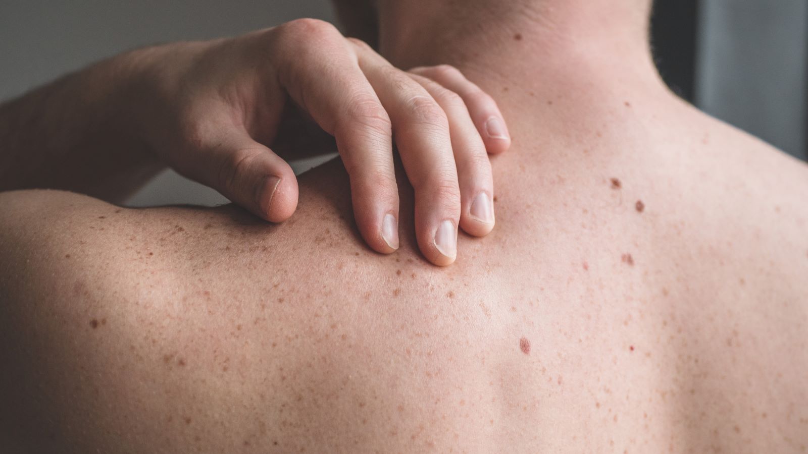 5 Risk Factors for Skin Cancer You Should Know