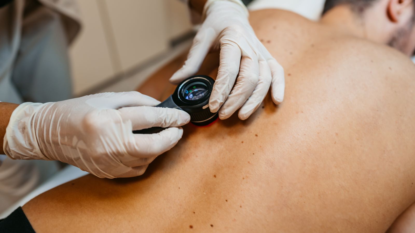 Where to Check for Skin Cancer, Based on Your Gender