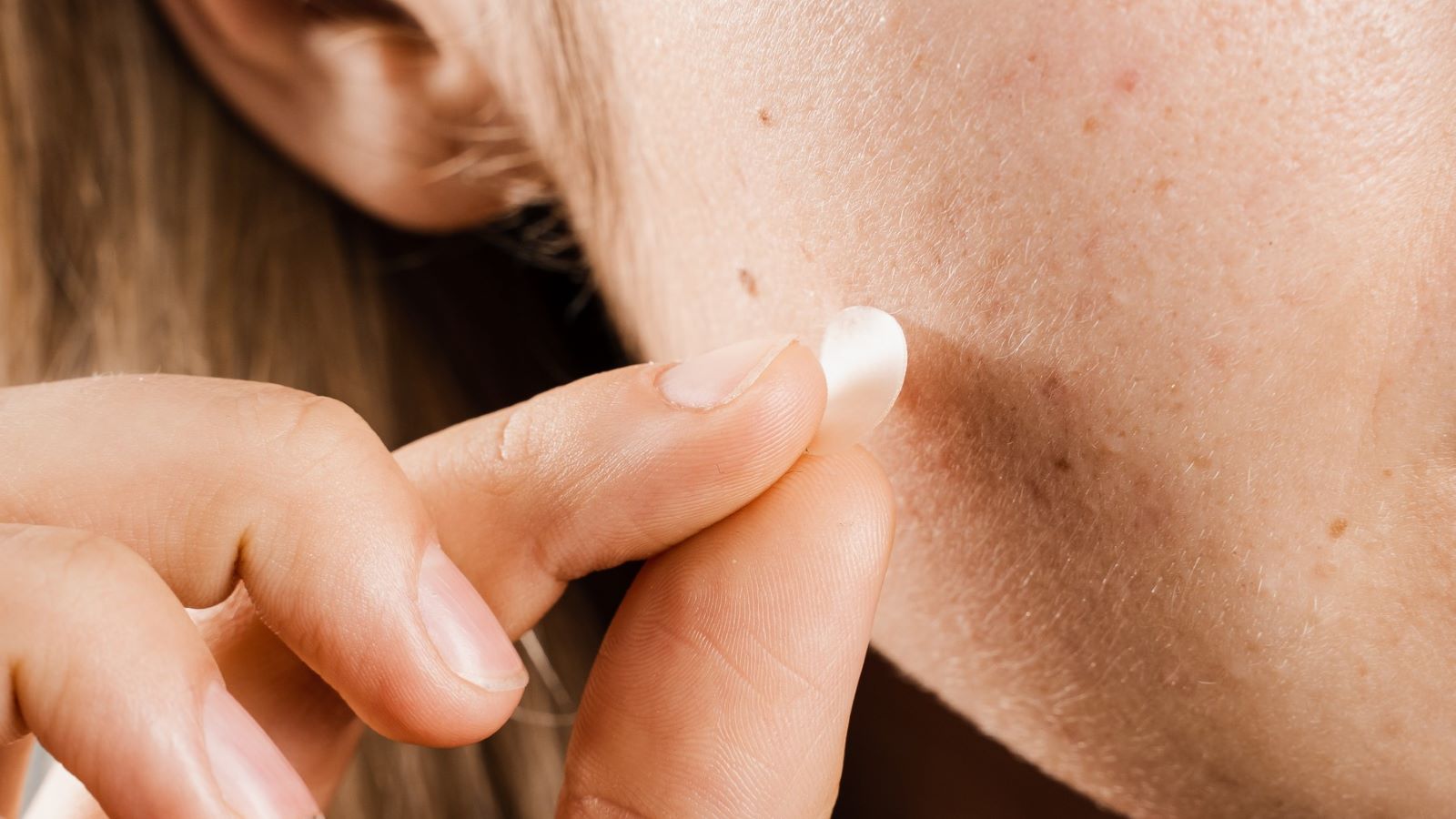 Do Pimple Patches Actually Work?