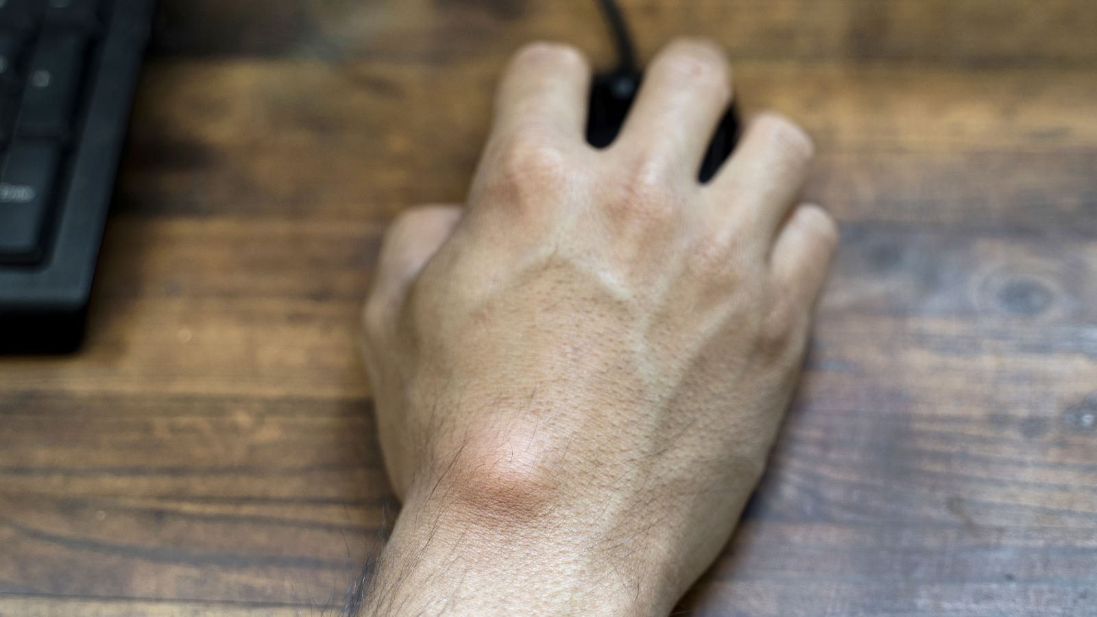 ganglion cyst