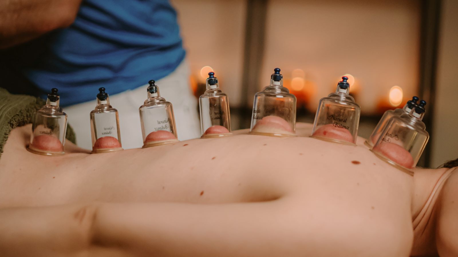 Does Cupping Actually Work?