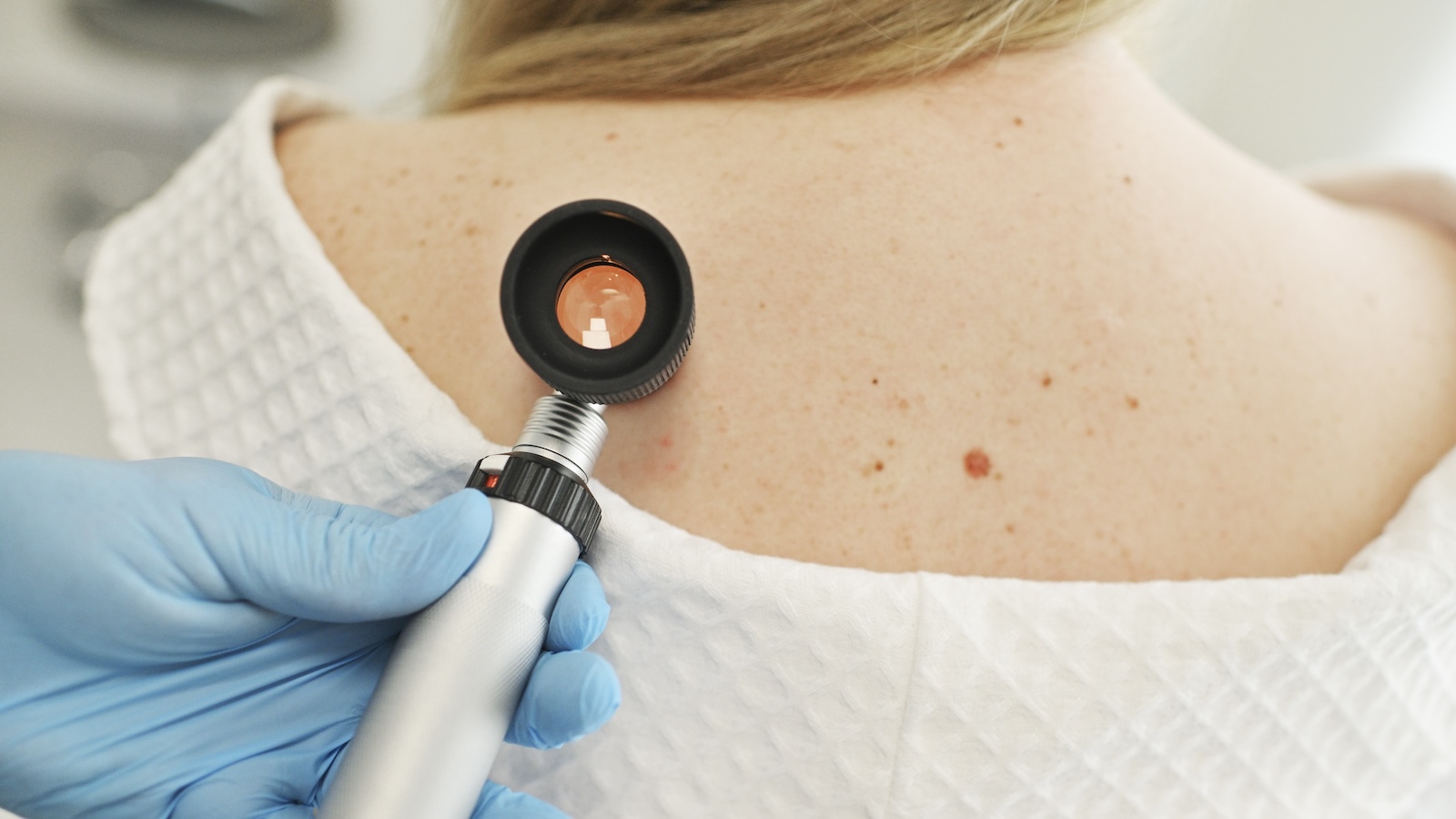 Skin Cancer Isn’t Just Moles. Watch for These 6 Signs